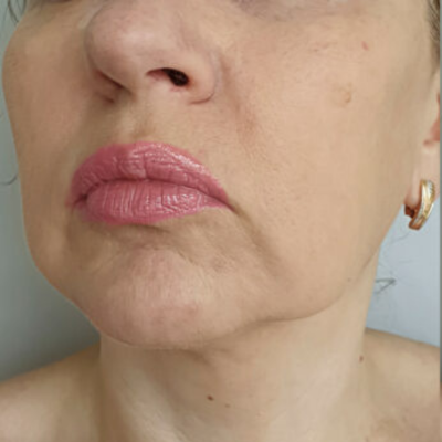 Antes - Pele com flacidez