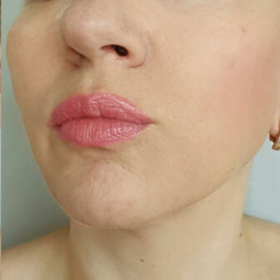 Depois - Pele firme e tonificada